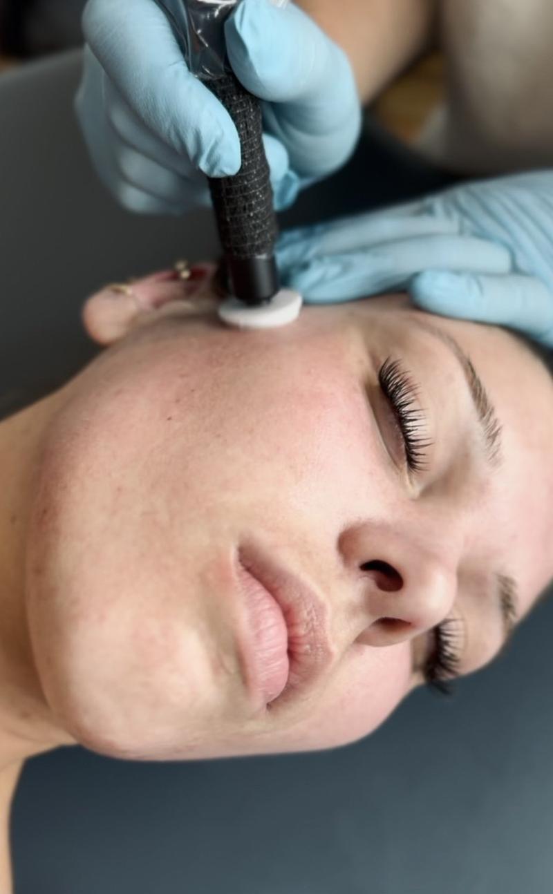 Procell Microchanneling vs. Traditional Microneedling: Why Southern Maine Clients Are Making the Switch