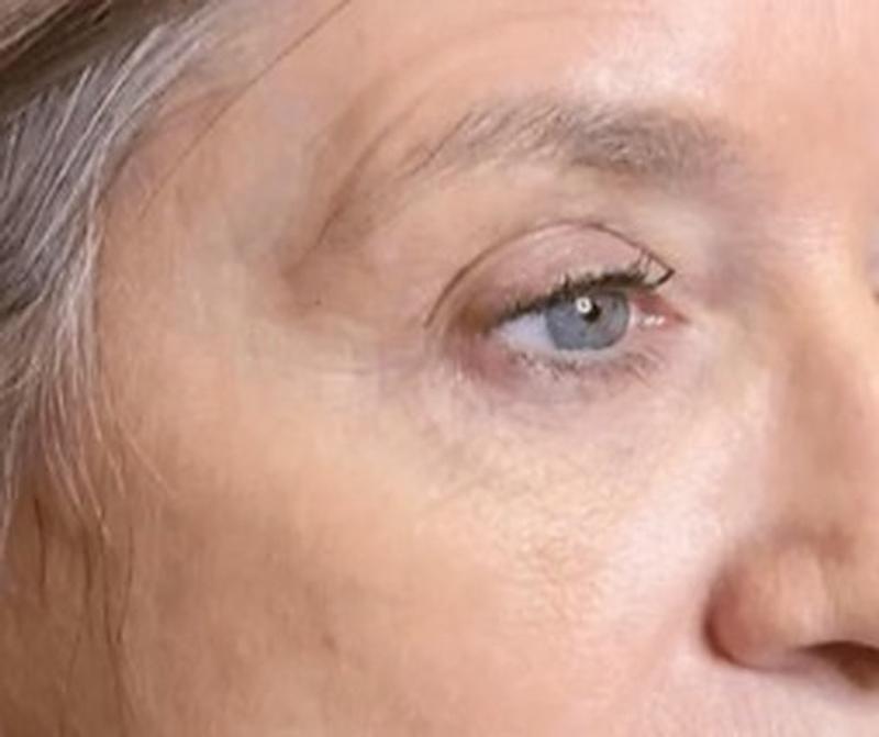 After Procell microchanneling: Fine lines and crow's feet, four treatments
