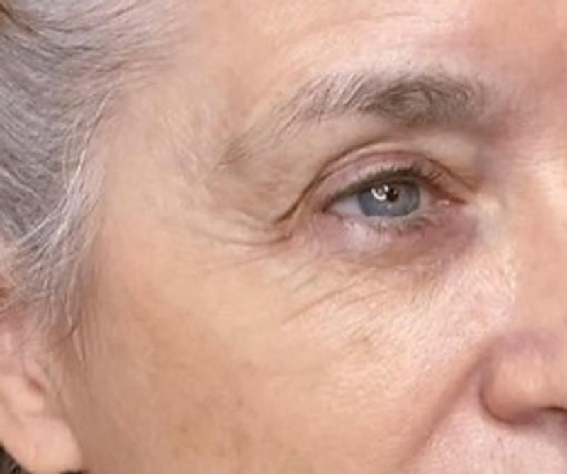 Before Procell microchanneling: Fine lines and crow's feet, four treatments