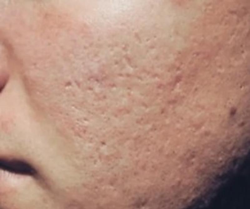 Before Procell microchanneling: Acne scarring, four treatments