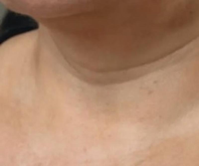 After Procell microchanneling: Neck lines, four treatments
