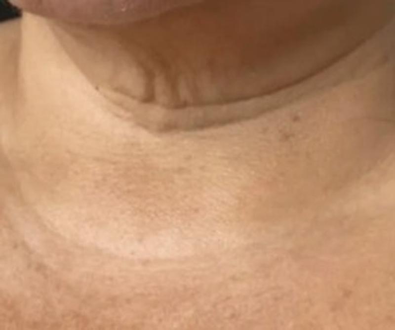 Before Procell microchanneling: Neck lines, four treatments