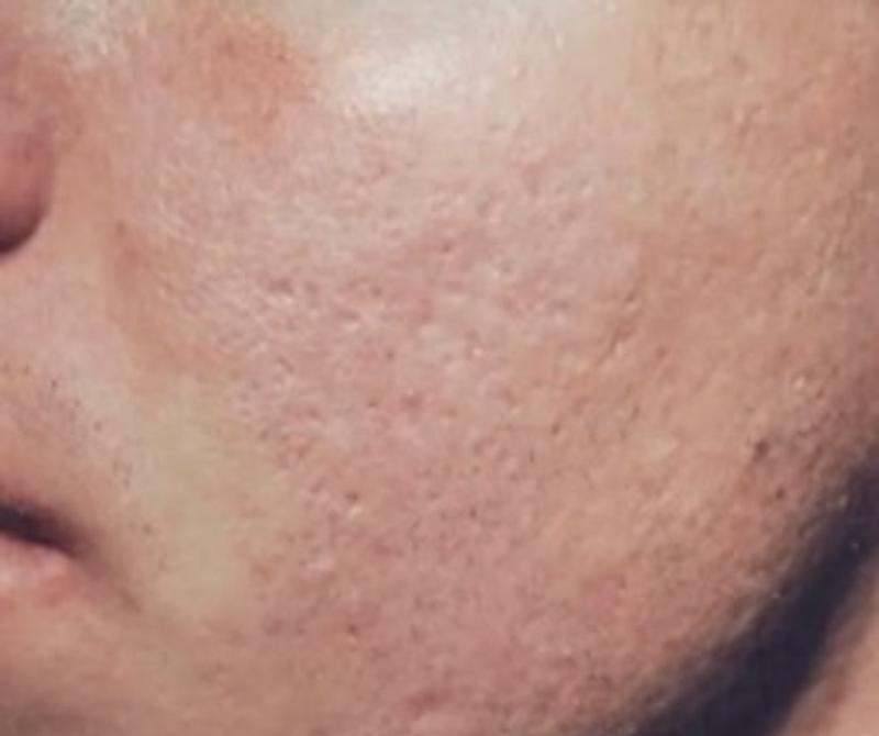 After Procell microchanneling: Acne scarring, four treatments
