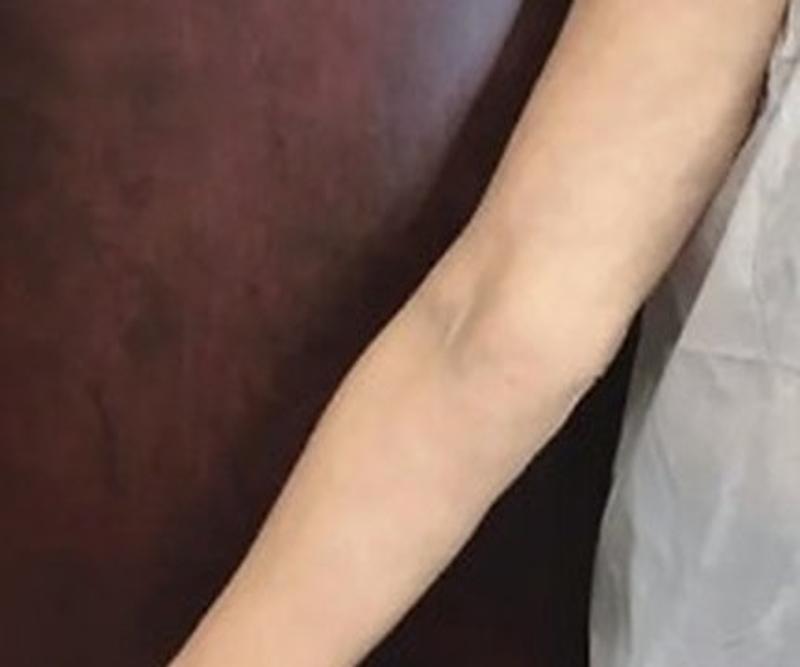 After Procell microchanneling: Crepey skin on the arm, two treatments