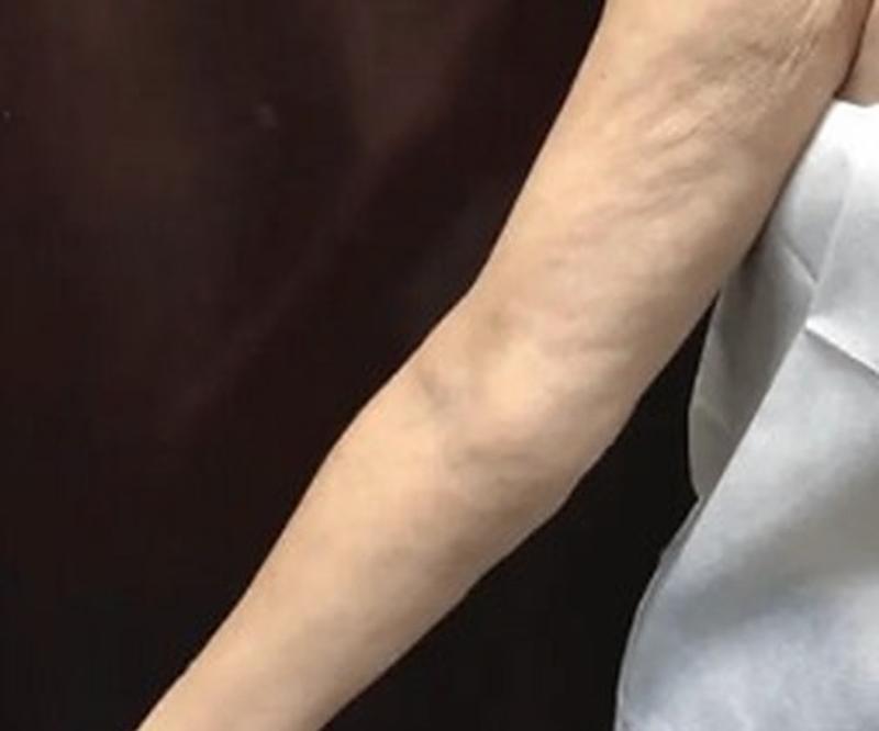 Before Procell microchanneling: Crepey skin on the arm, two treatments